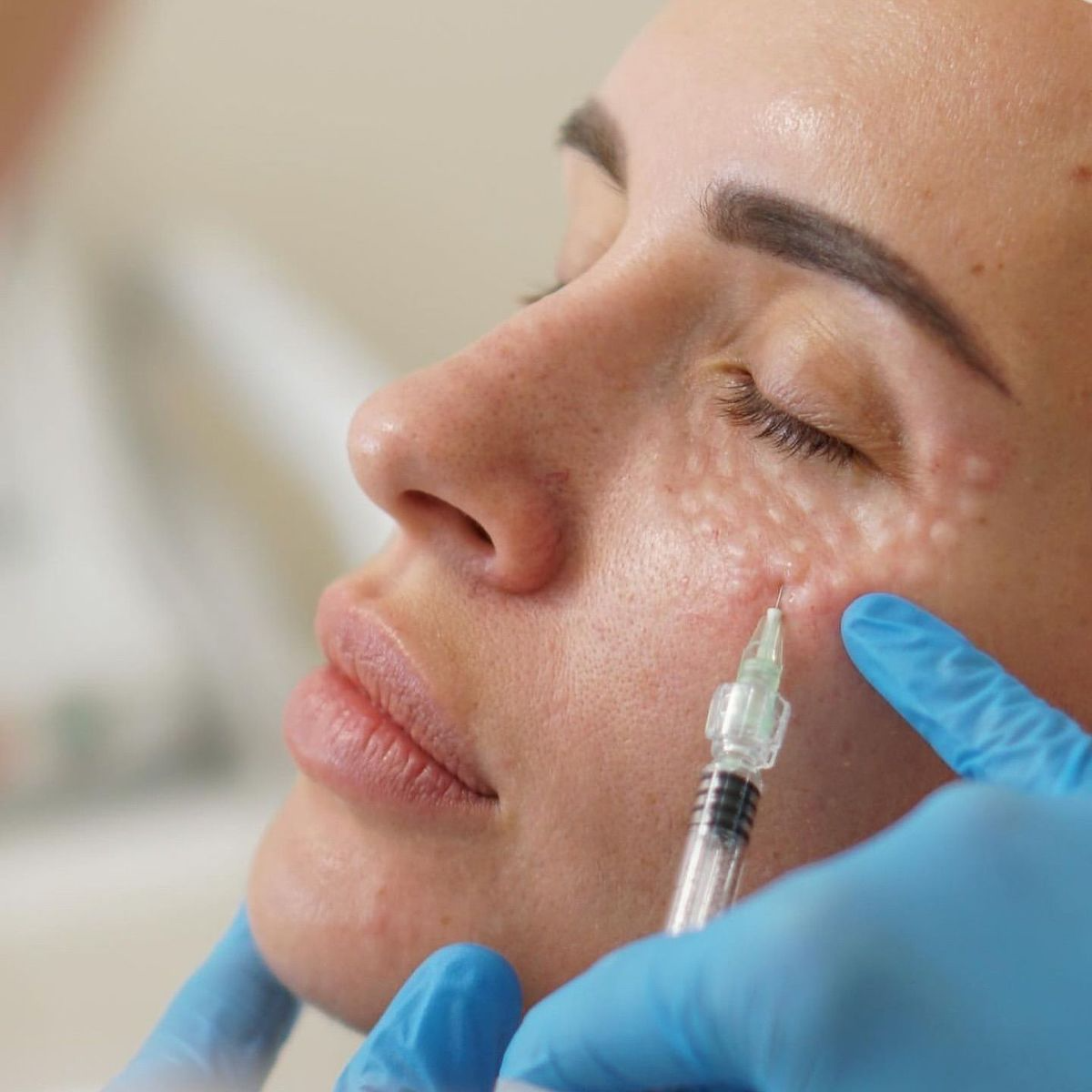 Polinucleótidos en Madrid: el tratamiento médico que regenera tu piel y rejuvenece tu mirada